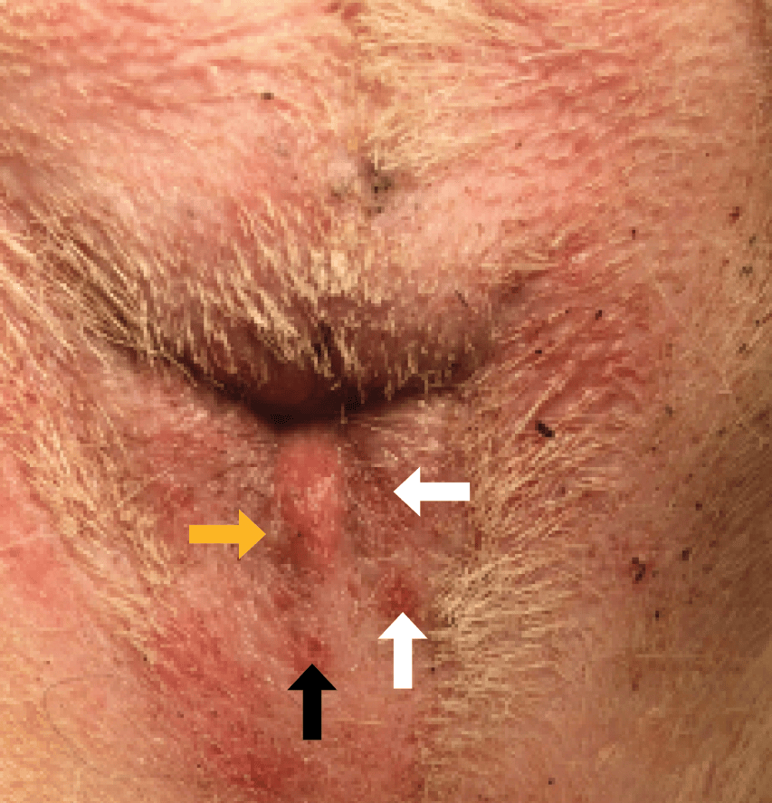 Mild case of anal furunculosis with draining tract