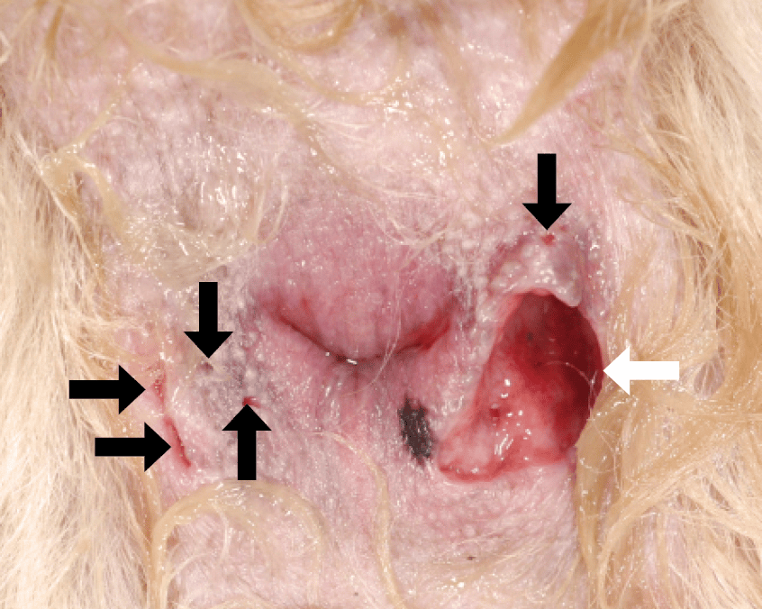 Severe case of anal furunculosis with several draining tracts